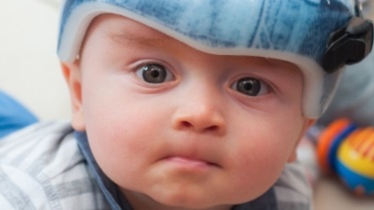 Scanning a baby’s head to make an orthotic helmet