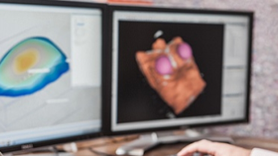 Сreating patient-specific chest implants with Artec 3D scanners and Geomagic Freeform software